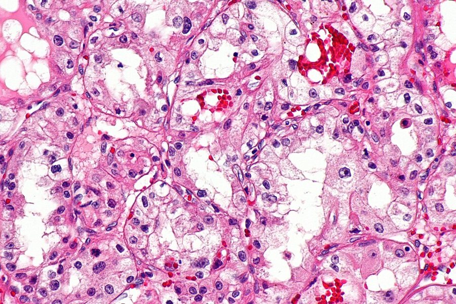 Les cancers : une cellule cancéreuse.